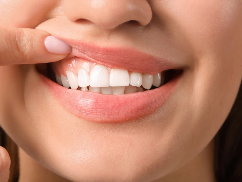 Cómo corregir la sonrisa gingival con ácido hialurónico de forma segura y natural
